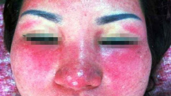 Cái giá phải trả cho việc ham trắng da cấp tốc Ảnh 2