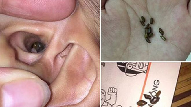 Chơi xúc cát, bé 4 tuổi suýt bị thủng màng nhĩ Ảnh 2