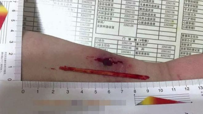 Lạ lùng người đàn ông bị đũa cắm vào tay hơn 1 tháng mới biết Ảnh 2