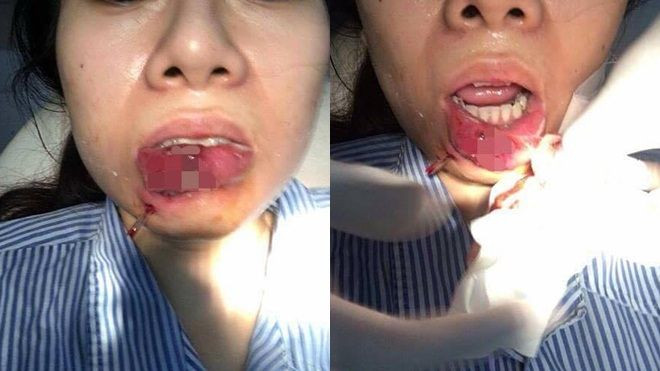 Xót xa cô gái Quảng Ninh phải cắt bỏ môi sau khi tiêm chất làm đầy Ảnh 2