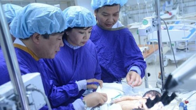 Cặp song sinh dính liền ở Hà Giang đã qua đời Ảnh 2