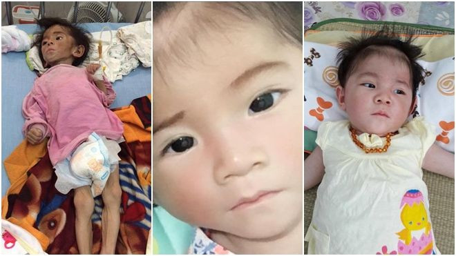 Yêu thương chính là điều kỳ diệu giúp bé gái 14 tháng nặng 3,5kg thay da đổi thịt như thế này! Ảnh 2