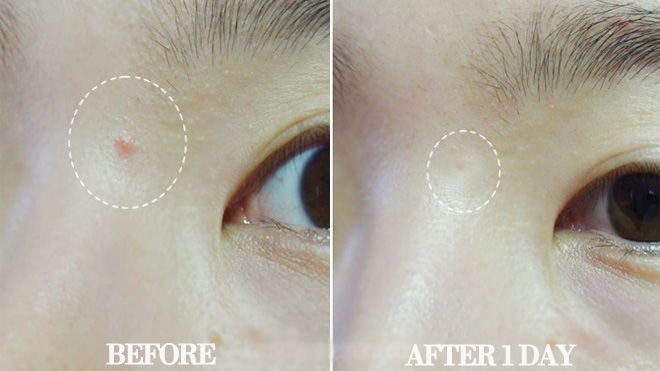 Review 4 sản phẩm dưới 350 nghìn được quảng cáo là 'thoa đến đâu mụn xẹp đến đấy' Ảnh 2