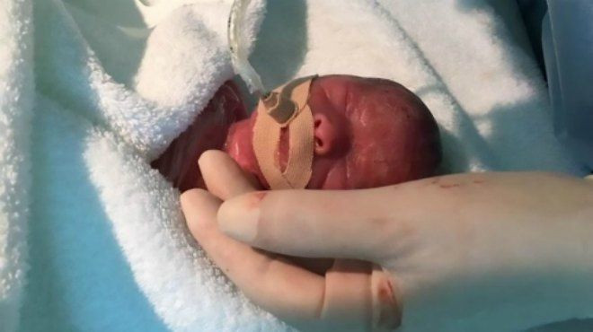 Đôi song sinh bé bằng lòng bàn tay Ảnh 2