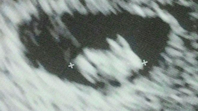 Mẹ bầu 7 tuần siêu âm thấy 'thỏ con' trong bụng Ảnh 2