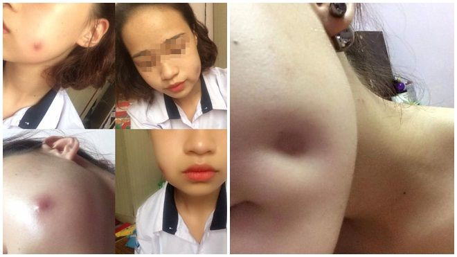 Bỏ tiền triệu làm má lúm và cái kết 'đắng lòng' của cô gái trẻ Ảnh 2