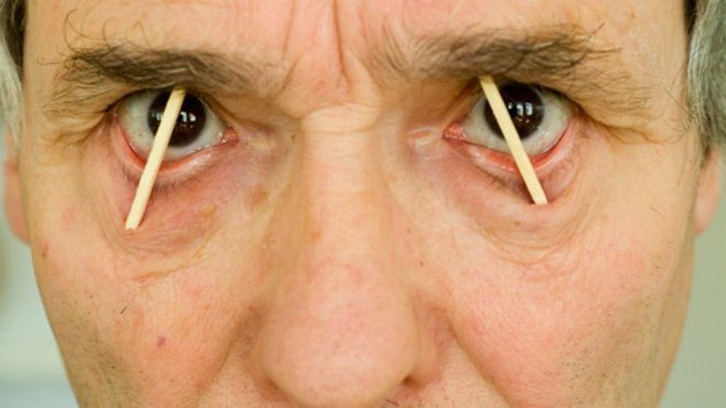 Bí ẩn 40 năm không ngủ của người đàn ông bị đạn bắn xuyên đầu Ảnh 2