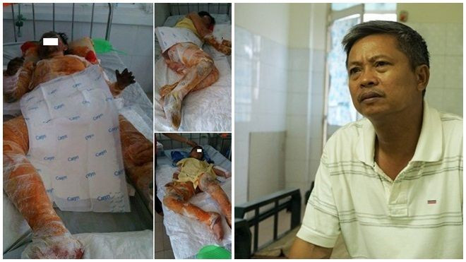 Cha hiến da ghép cho con gái bị bỏng nặng Ảnh 2