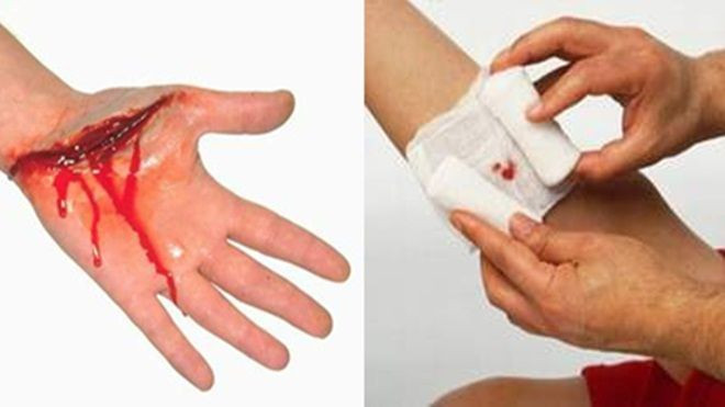 Vụ bé trai bị tôn cứa cổ gây tử vong: Cách sơ cứu chuẩn nhất để giúp người bị nạn Ảnh 2