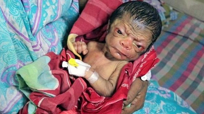 Nghẹn lời khi em bé vừa lọt lòng đã mang khuôn mặt của ông lão 80 tuổi Ảnh 2