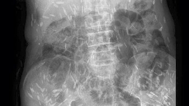 Hoảng hồn sán di chuyển khắp cơ thể, biến người phụ nữ thành 'người gạo' Ảnh 2