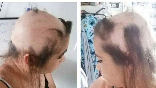 Cô gái bị rụng gần hết tóc vì thất tình Ảnh 2