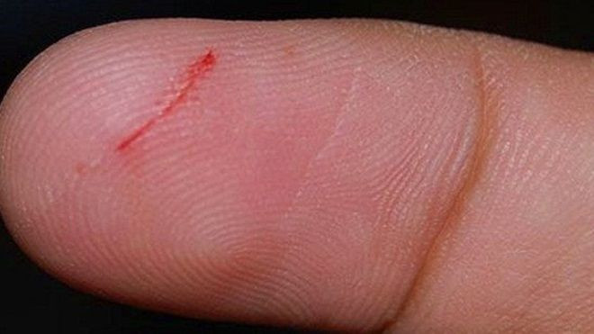 Tử vong vì một vết xước ở tay: Cảnh báo căn bệnh 'giết' nhiều người hơn cả ung thư và AIDS Ảnh 2