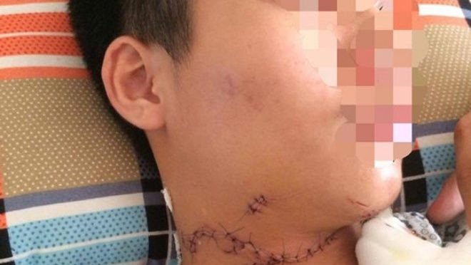 Hà Nội: 2 học sinh đi xe đạp điện va chạm vào đống tôn, bị cứa đứt tai và cổ Ảnh 2