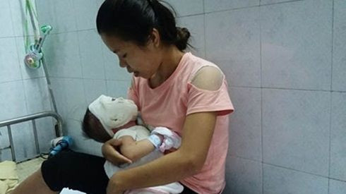 Mẹ sơ sẩy, con trai 11 tháng tuổi bị ấm nước siêu tốc đổ xuống đầu, bỏng nặng toàn thân Ảnh 2