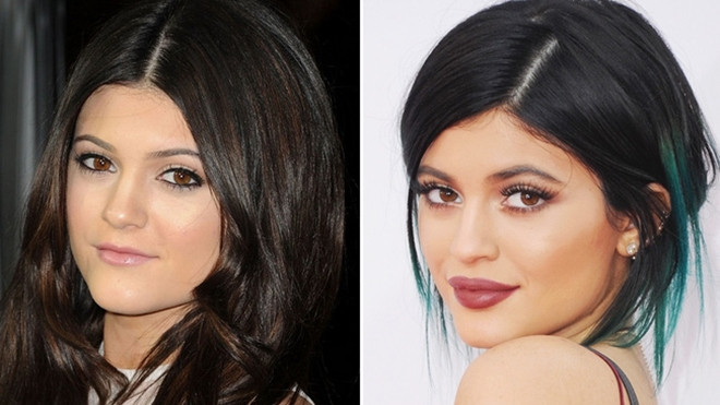 Không phải cứ tiêm môi là sẽ thành Kylie Jenner đâu nhé các nàng! Ảnh 2