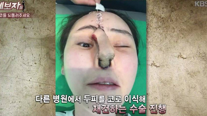 Phẫu thuật thẩm mỹ hỏng, cô gái Hàn Quốc nhận hậu quả đáng sợ Ảnh 2