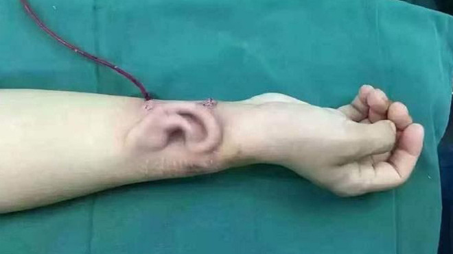 Hình ảnh gây sốc: Tai mọc trên cánh tay người! Ảnh 2