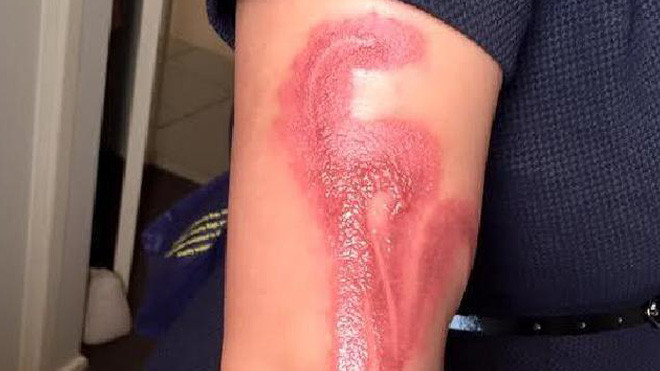 Đang dùng iPhone 7 thì ngủ gật, sáng dậy thấy bỏng nặng cấp độ 2 Ảnh 2