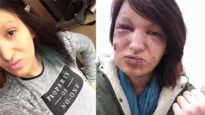 Cô gái xinh đẹp bị biến dạng vì tình cũ ghen tuông cắn 21 phát vào mặt Ảnh 2