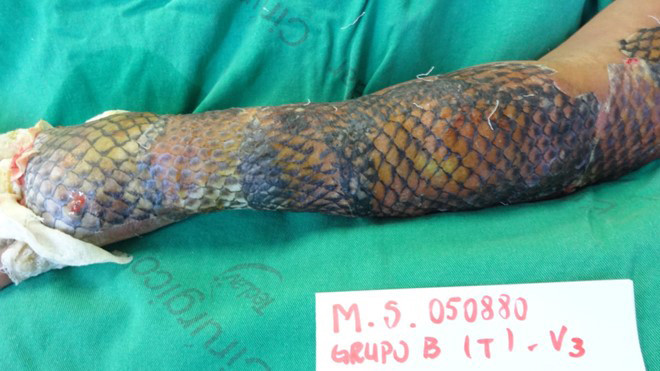 Kinh ngạc với phương pháp chữa bỏng bằng da cá rô phi Ảnh 2