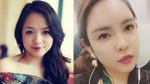 Thời tiêm filler đã qua rồi, giờ là mốt lấy mỡ tự thân cấy lên… mặt cơ! Ảnh 2