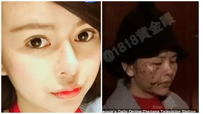 Mất 200 triệu 'dao kéo', cô gái trẻ bị bạn thân ghen tỵ, hủy hoại nhan sắc Ảnh 2