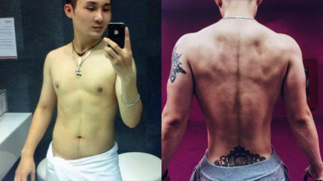 Bất chấp đau đớn, chàng trai chi 750 triệu đồng cắt bỏ xương sườn để có vòng eo bé xíu Ảnh 2
