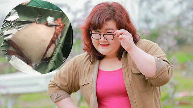 Á quân 130kg của chương trình thực tế khoe tảng mỡ bụng khổng lồ sau phẫu thuật giảm béo Ảnh 2