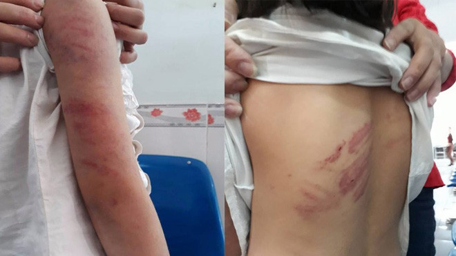 Bố say rượu liên tục đánh, đạp vào bụng con gái 9 tuổi ở Vĩnh Phúc Ảnh 2