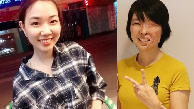 Hành trình một năm tái tạo gương mặt cho nữ sinh bị tạt axit ở Sài Gòn Ảnh 2