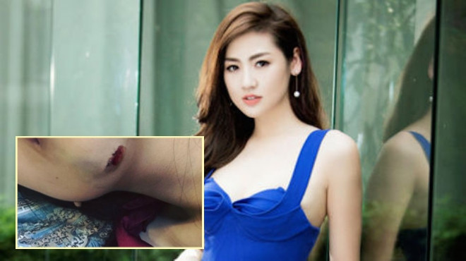 Cận cảnh chiếc cằm của Á hậu Tú Anh sau khi bị ngã phải khâu 7 mũi Ảnh 2