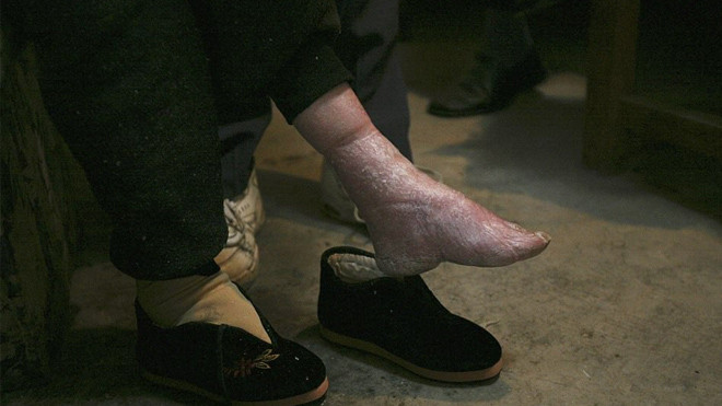 Nỗi đau của những người phụ nữ cuối cùng theo tục bó chân ở Trung Quốc Ảnh 2