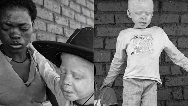 Nạn săn người bạch tạng ở châu Phi Ảnh 2