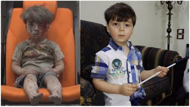 Cậu bé Syria mình đầy thương tích và bê bết máu sau một năm giờ thế nào? Ảnh 2