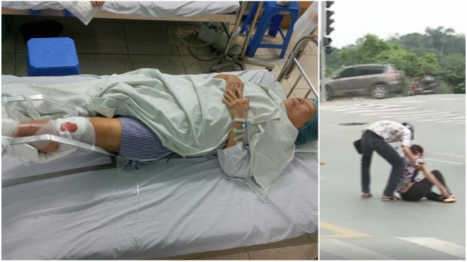 Nạn nhân trong clip tông xe rồi bỏ chạy ở trước nhà chờ xe buýt nhanh BRT bị gãy xương, chấn động não Ảnh 2