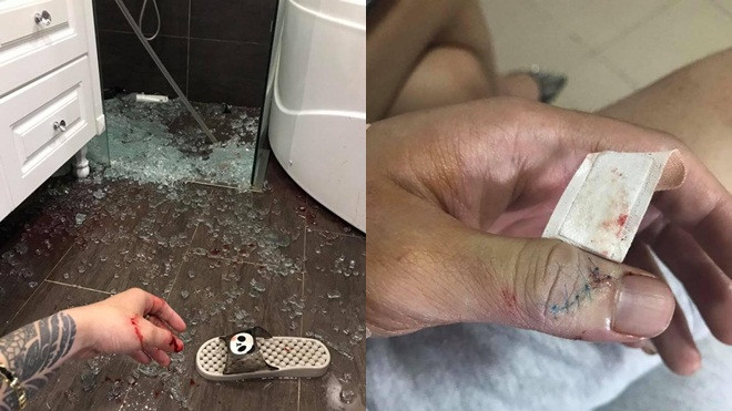 Phải vào bệnh viện vì kính cường lực trong phòng tắm đột nhiên phát 'nổ như bom’ Ảnh 2