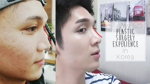 Nam giới Hàn Quốc đua nhau đi phẫu thuật thẩm mỹ để trở thành “trai xinh” như thần tượng Ảnh 2
