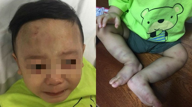 Xác định nhân thân bé trai nhập viện trong tình trạng thâm tím khắp cơ thể Ảnh 2
