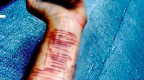 Mắc chứng bệnh lạ, nữ sinh cắt 16 vết trên cánh tay không thấy đau Ảnh 2