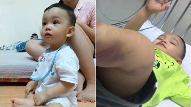 Hình ảnh mới nhất của bé trai 14 tháng tuổi bị bạo hành, bỏ rơi ở bệnh viện sau 5 ngày về nhà Ảnh 2
