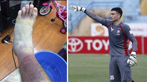 Tuyển thủ Đặng Văn Lâm 'khoe' vết bầm cực lớn do bị Sỹ Mạnh đuổi đánh Ảnh 2