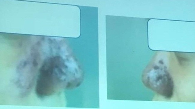 Nhiễm trùng mũi, lồi má vì làm đẹp ở spa tại gia Ảnh 2