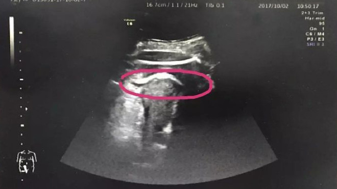 Hy hữu: Mẹ bầu 8 tháng suýt chết vì thai nhi đạp thủng tử cung Ảnh 2