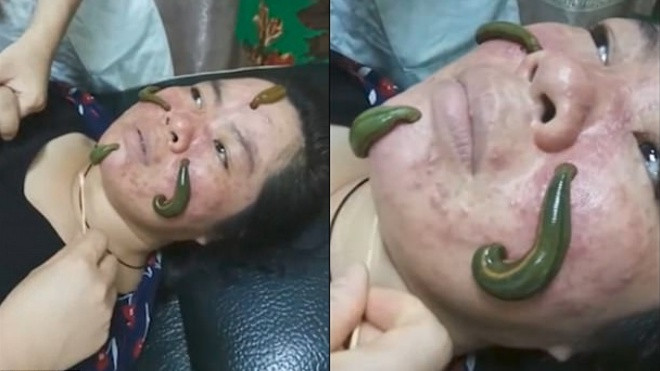 Cho đỉa bò lên mặt hút mụn - Làm đẹp kiểu kinh dị Trung Quốc chắc không ai dám thử Ảnh 2