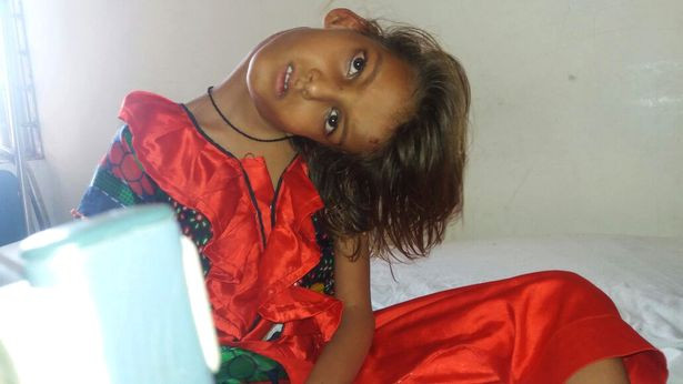 Căn bệnh lạ khiến cô bé nghiêng đầu 90 độ, bị cả làng xa lánh Ảnh 2