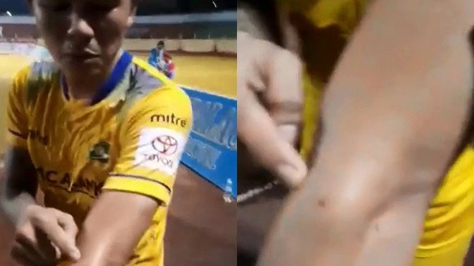 Cựu tuyển thủ Việt Nam tố bị ngoại binh cắn sưng tay Ảnh 2