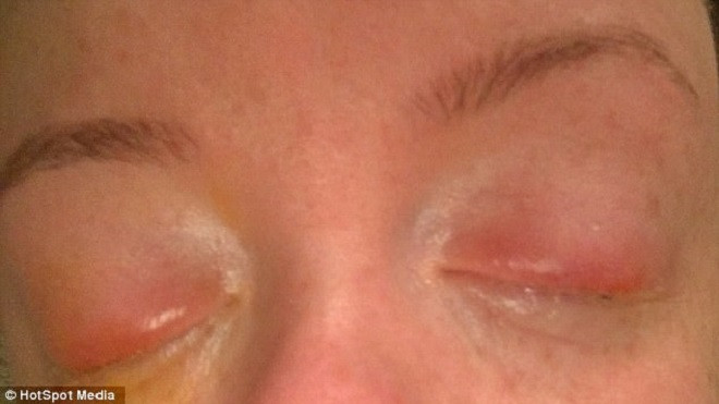 Thiếu nữ suýt bị mù vì hóa trang trong ngày Halloween Ảnh 2