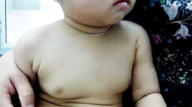 Mẹ hốt hoảng khi con gái 22 tháng tuổi có ngực to bất thường Ảnh 2