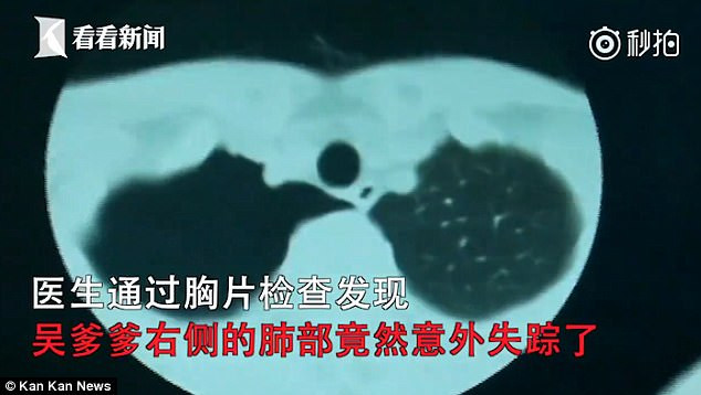 Được giác hơi ở nhà, người đàn ông bỗng dưng mất… phổi Ảnh 2